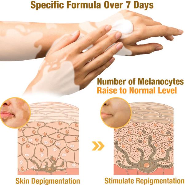 Fivfivgo™ BeeVenom Vitiligo ( 7 Days Result ) Treatment Cream- BUY 1 GET 1 FREE ⭐️⭐️⭐️⭐️ 4.9/5 Reviews