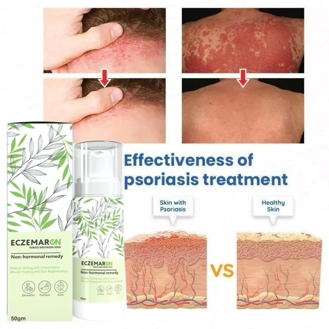 Eczemaron Anti Fungal Cream 50gm | Buy 1 Get 1 Free | ⭐️⭐️⭐️⭐️ 4.9/5 Reviews