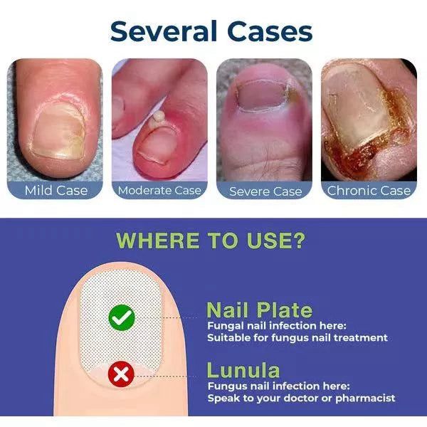 Anti Paronychia Relief Oil ( BUY 1 GET 1 FREE )