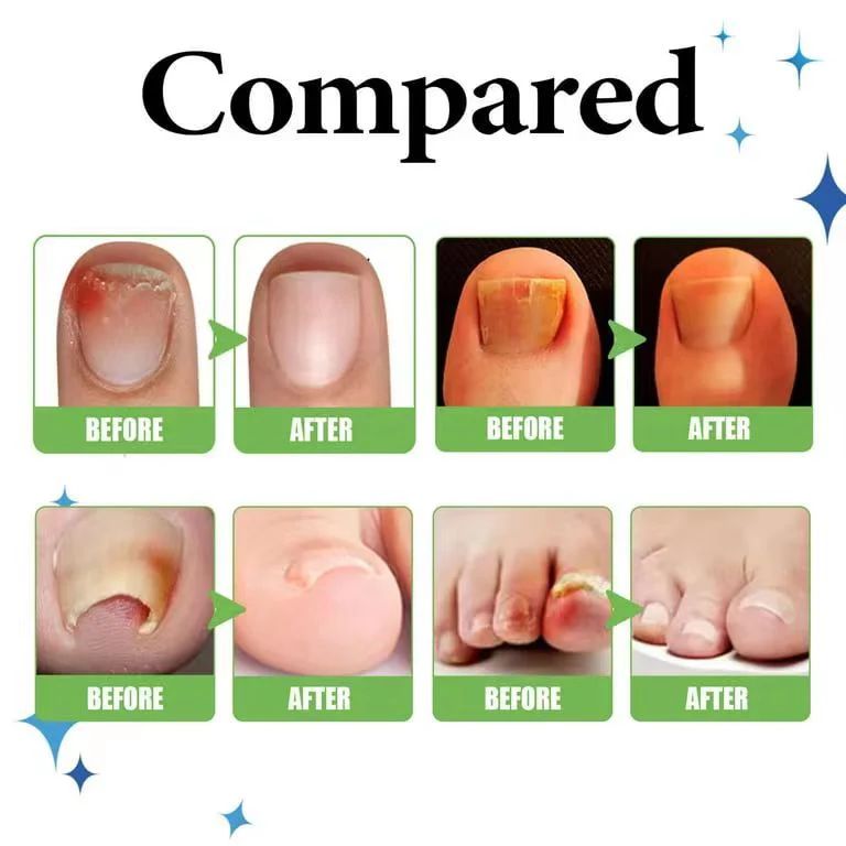 Anti Paronychia Relief Oil ( BUY 1 GET 1 FREE )