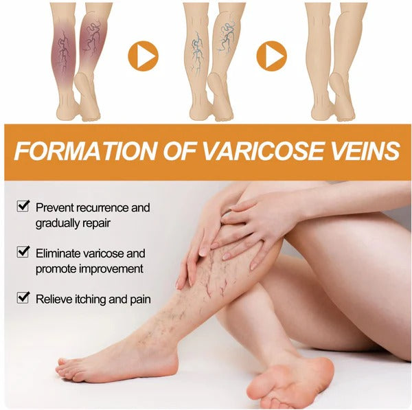 Turmeric Varicose Vein Relief Spray (BUY 1 GET 2 FREE 😍)
