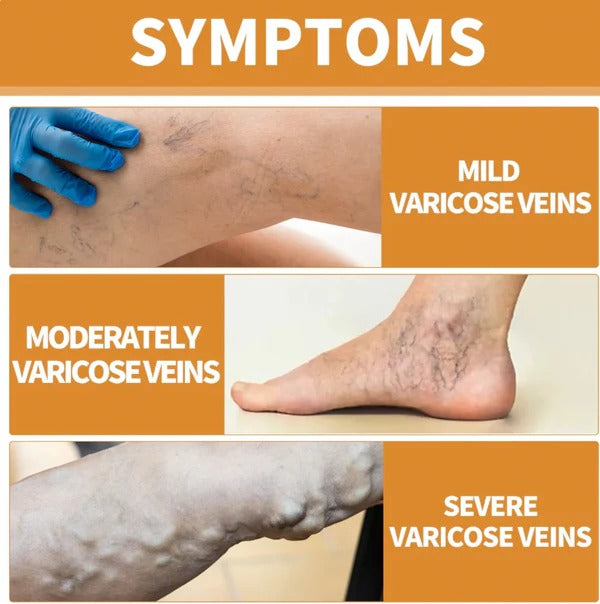 Turmeric Varicose Vein Relief Spray (BUY 1 GET 2 FREE 😍)