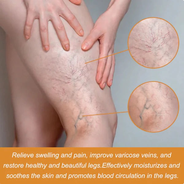 Turmeric Varicose Vein Relief Spray (BUY 1 GET 2 FREE 😍)