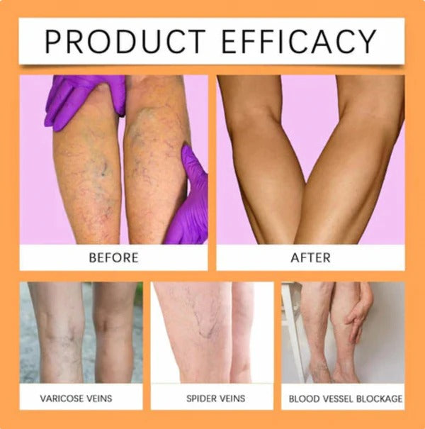 Turmeric Varicose Vein Relief Spray (BUY 1 GET 2 FREE 😍)