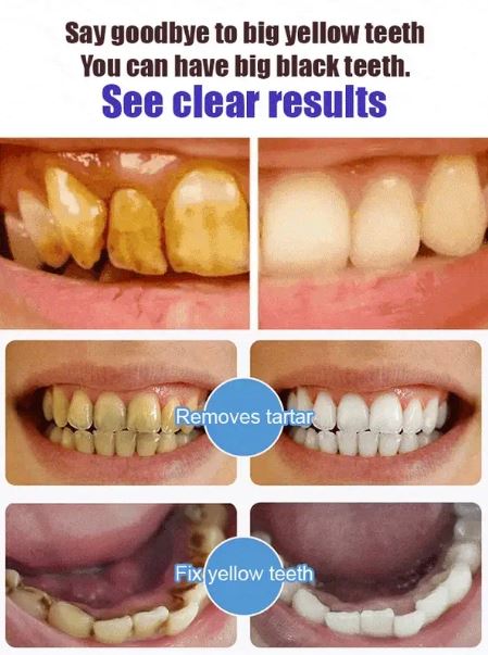 SP 4 Intensive Teeth Whitening Toothpaste ( BUY 1 GET 1 FREE ) ⭐️⭐️⭐️⭐️ 4.9/5 Reviews