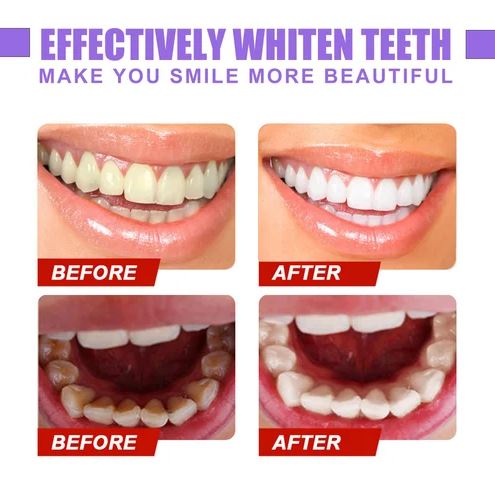 🔥LAST DAY 55% OFF🔥Teeth Colour Corrector Serum