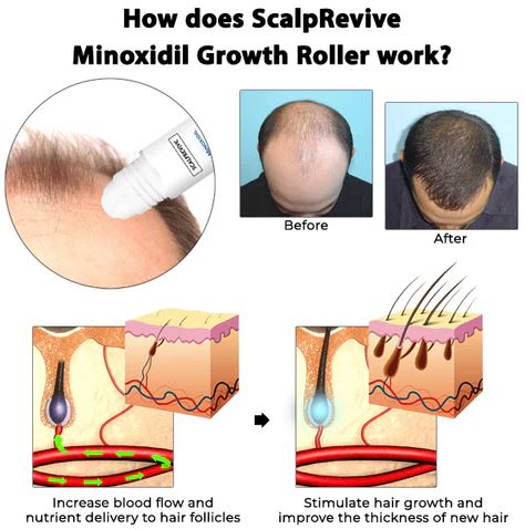 Fivfivgo™ ScalpRevive Minoxidil Growth Roller-( BUY 1 GET 1 FREE )
