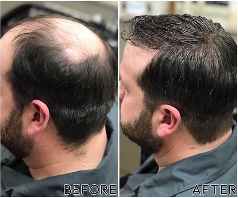 Fivfivgo™ ScalpRevive Minoxidil Growth Roller-( BUY 1 GET 1 FREE )