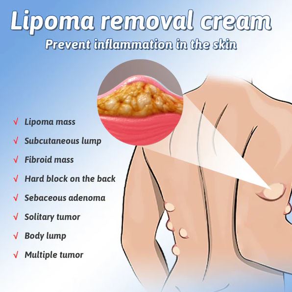 LipoCare™ | Doctor's No 1 choice | Lipoma Removal Cream 🩺- ( BUY 1 GET 1 FREE )⭐️⭐️⭐️⭐️ 4.9/5 Reviews