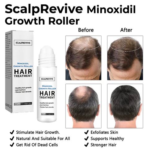 Fivfivgo™ ScalpRevive Minoxidil Growth Roller-( BUY 1 GET 1 FREE )