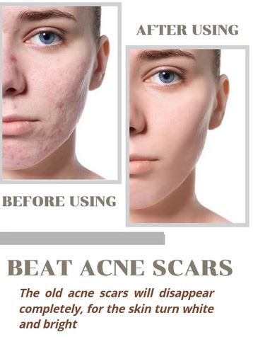 🤩Fight And Fade Acne Marks Niacid Face Serum [🔥Buy 1 Get 1 Free🔥]🤩