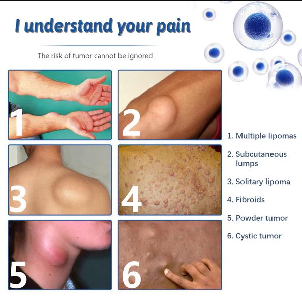 LipoCare™ | Doctor's No 1 choice | Lipoma Removal Cream 🩺- ( BUY 1 GET 1 FREE )⭐️⭐️⭐️⭐️ 4.9/5 Reviews